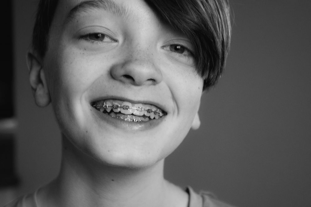 Tannregulering | Smilet du drømmer om er innen rekkevidde!